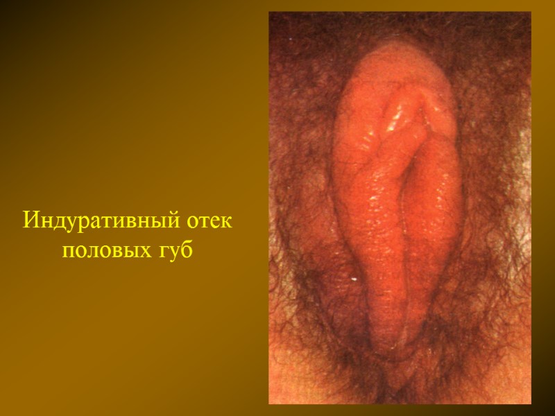 Индуративный отек половых губ